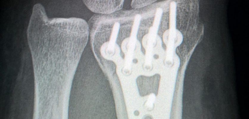 xray detailing bone screws in patient's wrist
